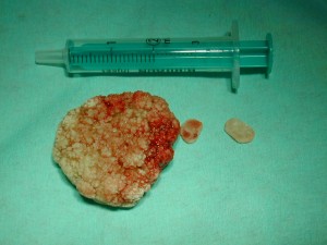 Durch Cystotomie entfernte Steine