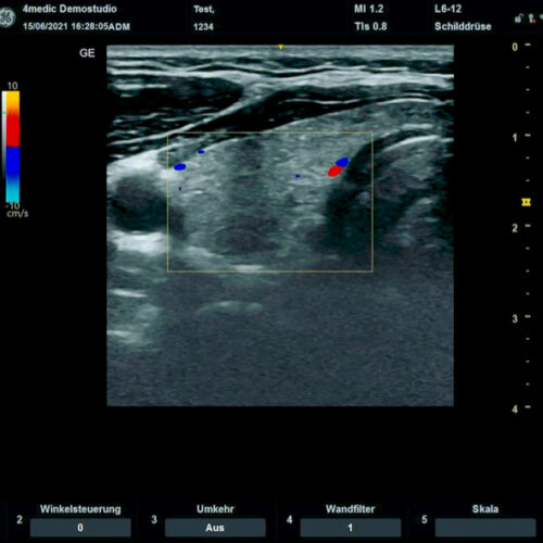 digitales ultraschall-bild