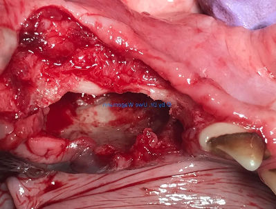 Eröffnete Zyste nach Entfernung der mit betroffenen Zähne und des retinierten Zahnes  