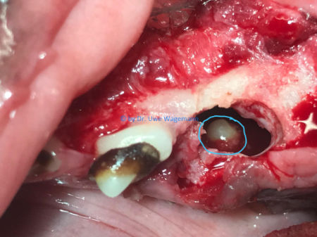 OP-Bild von Eröffnung der Zyste mit Blick auf den nicht retinierten Zahn