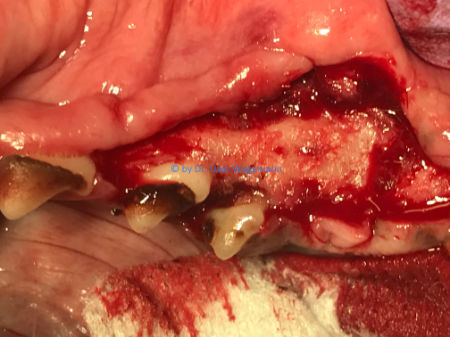 OP-Bild von Präparation und Zugang zum Kieferknochen über der Zyste          