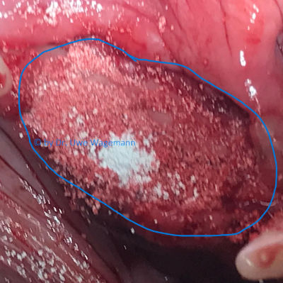 OP-Bild Abschluss der OP mit zugenähter und aufgefüllter Wunde