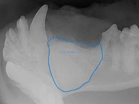 Mit Knochenersatzmaterial Synergy aufgefüllter Kiefer